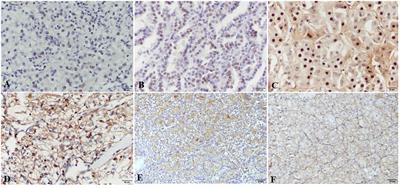 Differential expression of HIF1A and its downstream target VEGFA in the main subtypes of renal cell carcinoma and their impact on patient survival